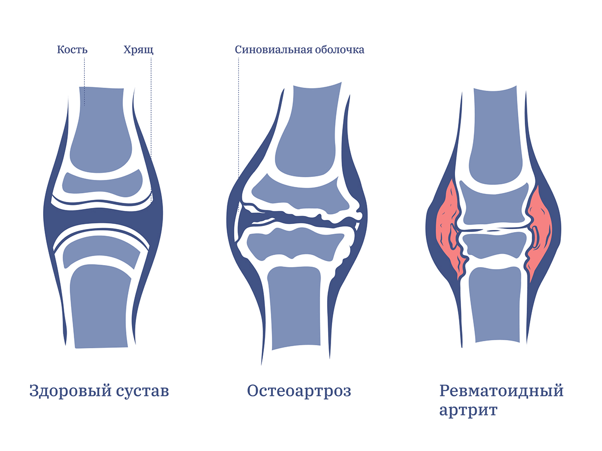 Стадии деформации коленного сустава