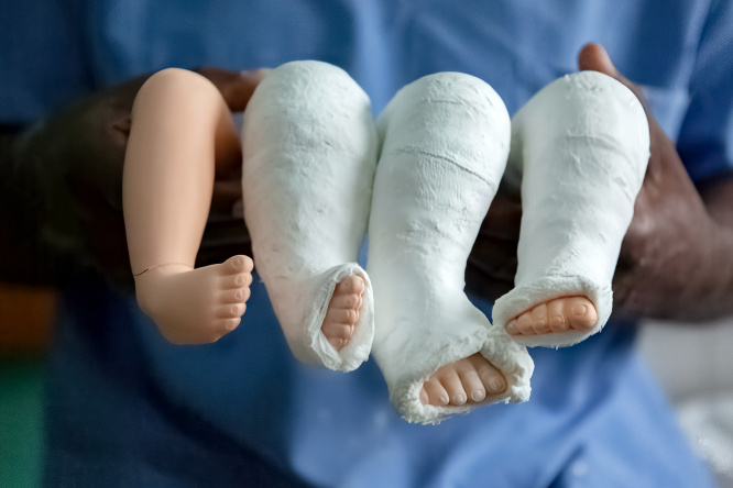 Лечебное гипсование